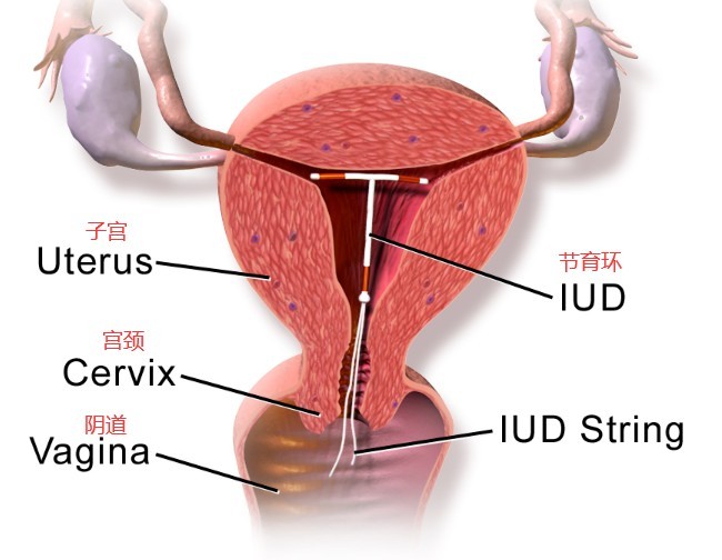 节育环的原理,阻断生育过程的科学原理