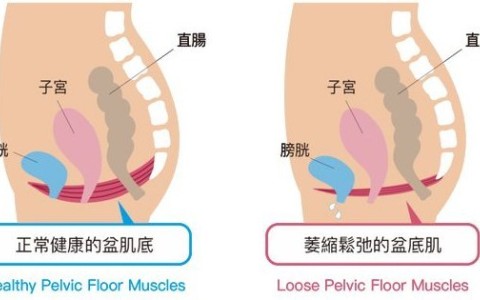 松弛怎么变紧致？女人都应该了解的凯格尔运动！