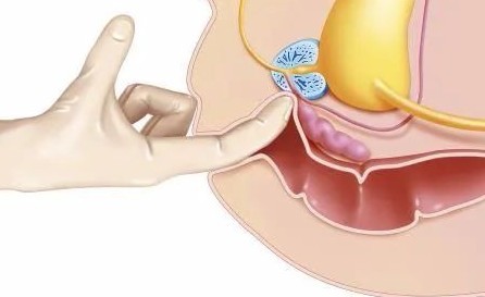 如何确定摸到了前列腺