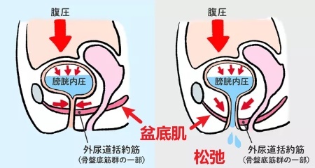 盆底肌松弛是什么样子