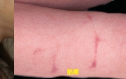 如何正确辨别掐痕和吻痕？附对比图片