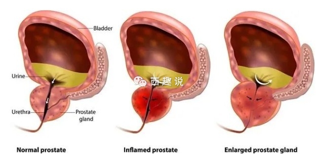 数据：十个男人九个有前列腺炎？