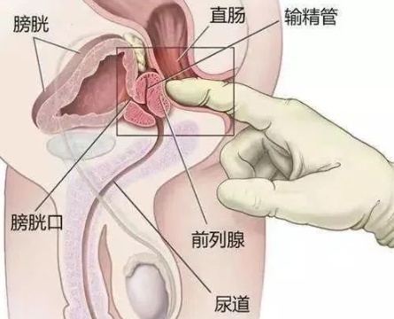 前列腺高潮一般激活要多久