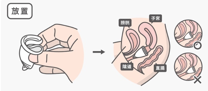 月经杯放里面会感到难受不舒服吗