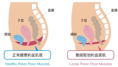 盆底肌不好的几个表现，你有吗？