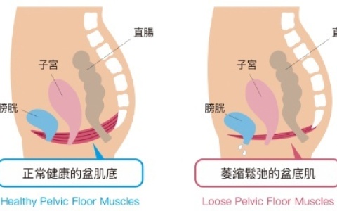 盆底肌不好的几个表现，你有吗？