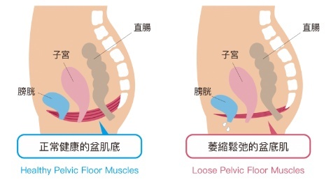 盆底肌通过锻炼可以收缩紧致吗