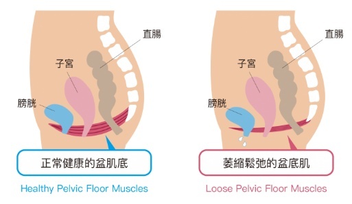 能憋住尿盆底肌算松弛吗