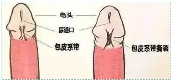 系带断了能让你后悔一辈子