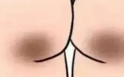 女生的屁股上，为什么会有两坨“黑印”