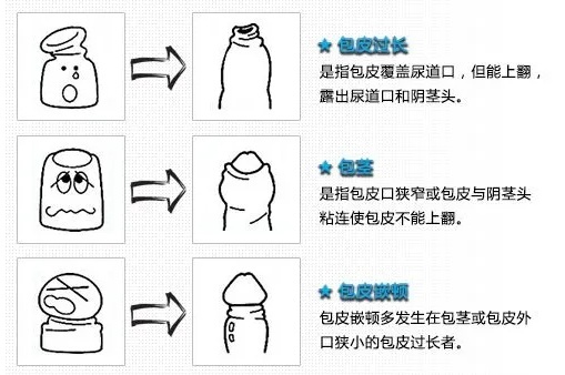 龟头敏感怎么办 4个方法增加龟头敏感度